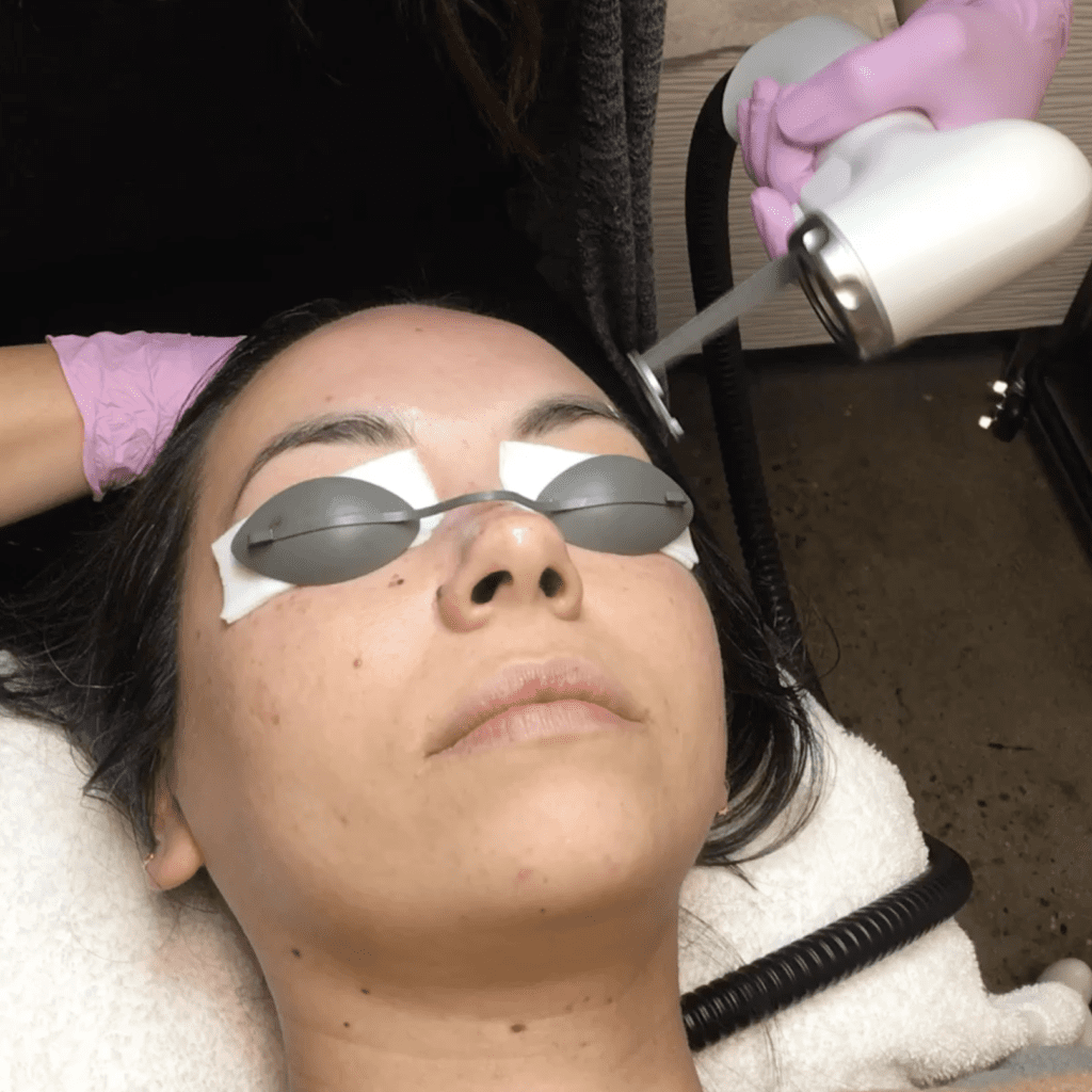 ADVATx Laser Treatment Grand Salon & MedSpa