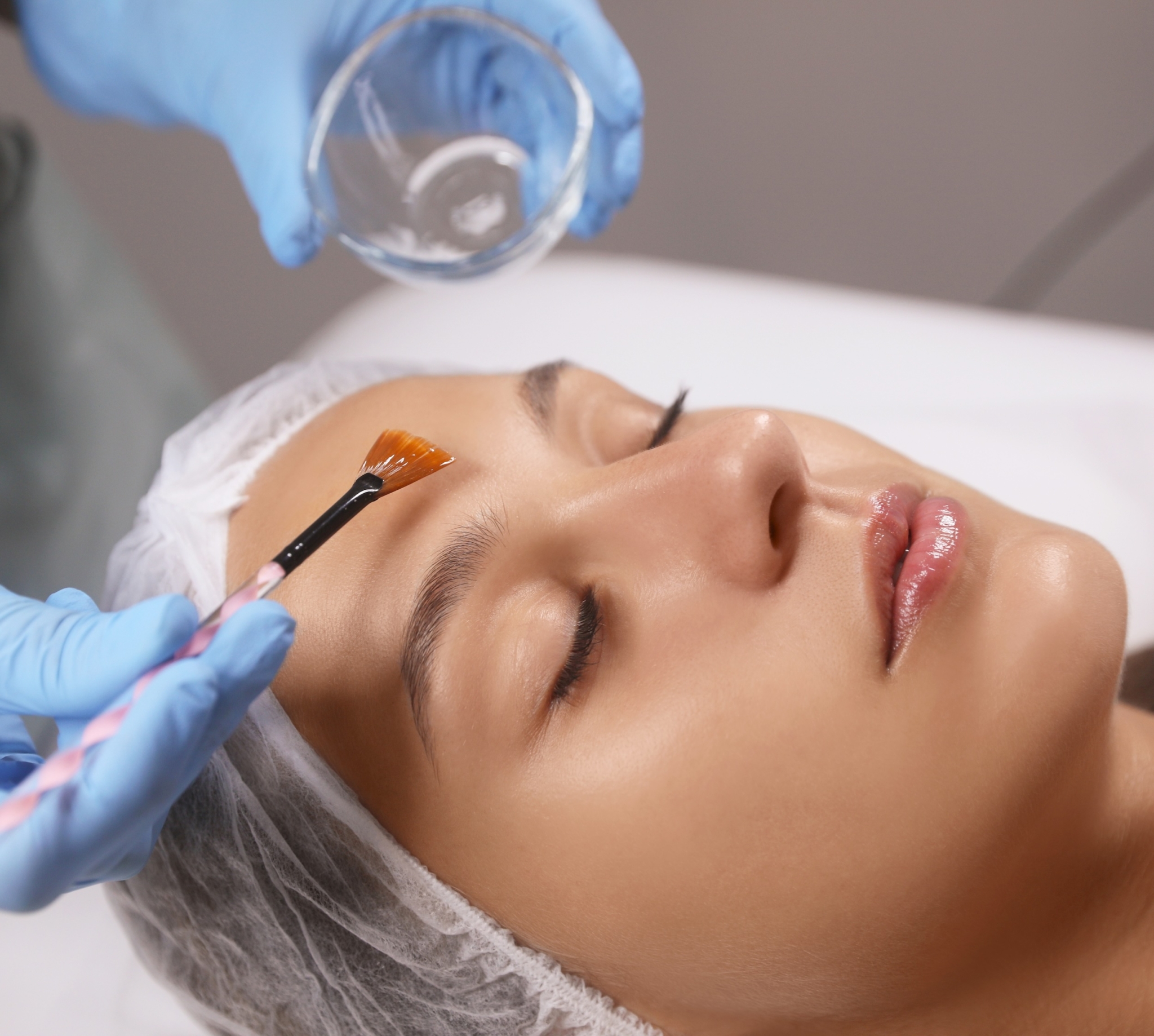 Chemical Peel treatment at Grand Salon & MedSpa