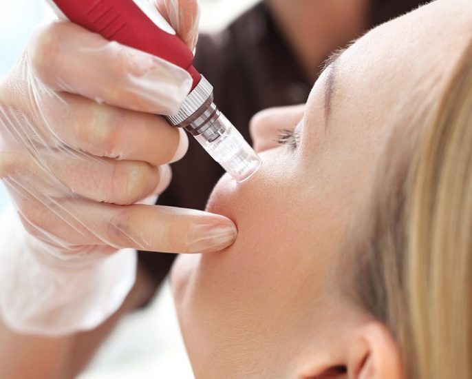 Microneedling treatment at Grand Salon & Medspa in Denver